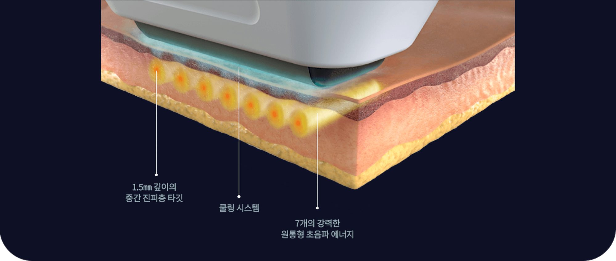 소프웨이브 작용 원리