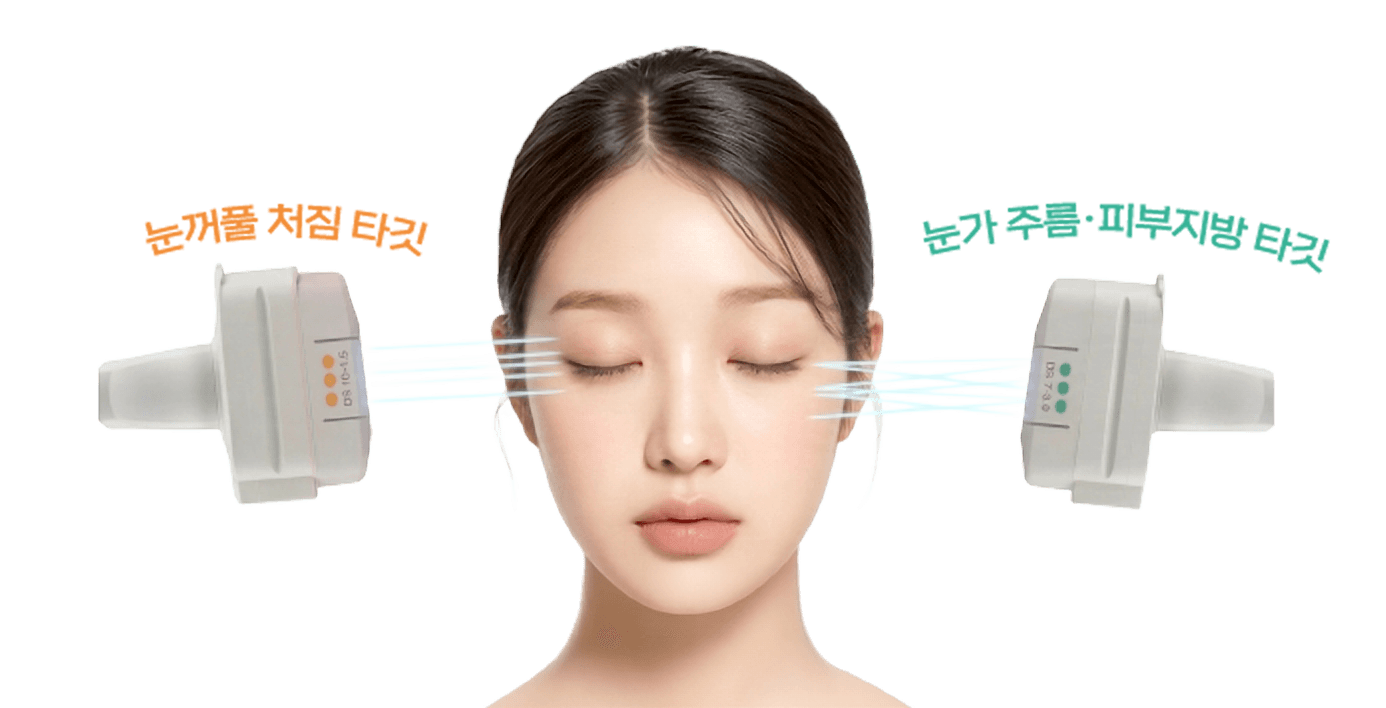 아이울쎄라 눈가 시술