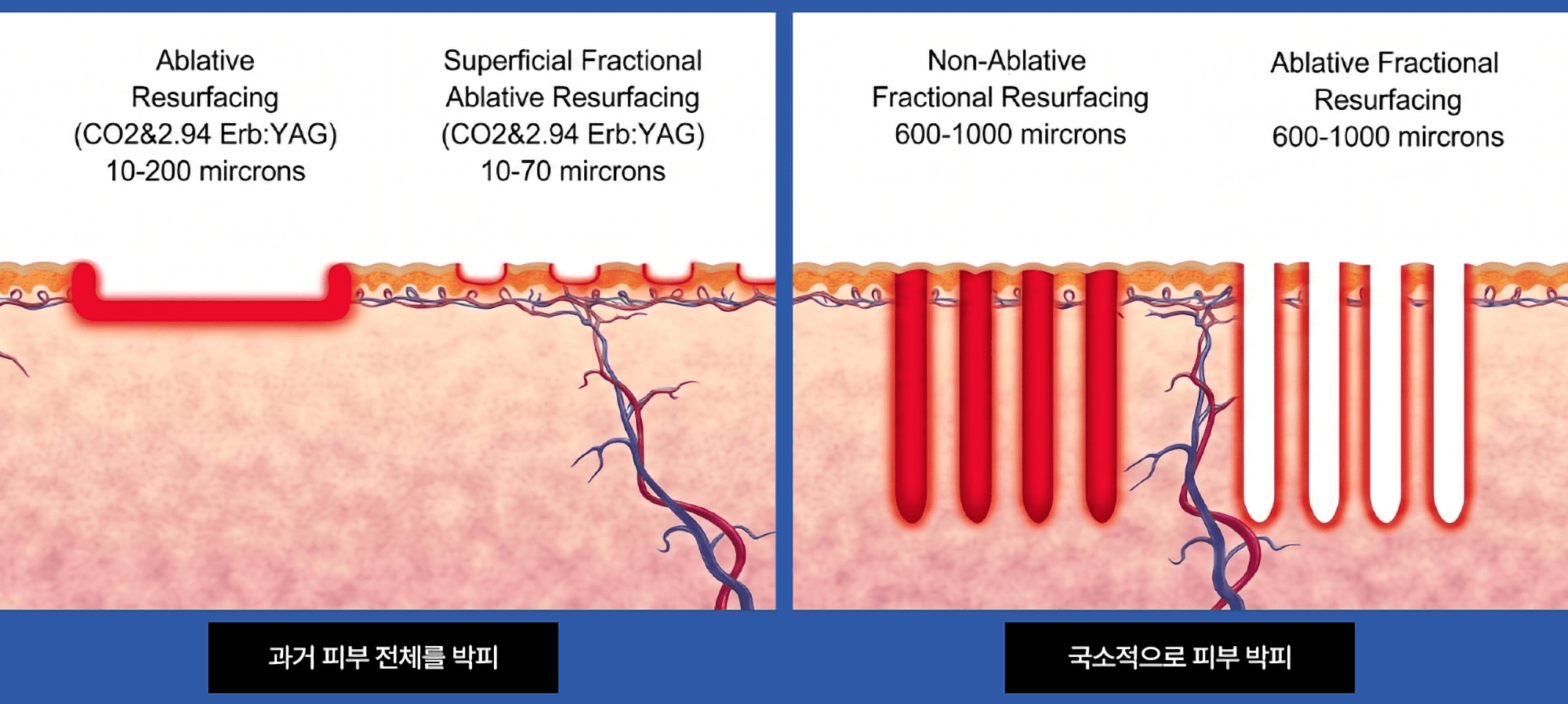 박피 레이저 방식 비교